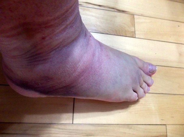Twisted Ankle Side-Before